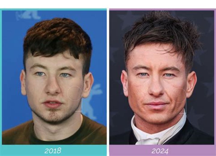 Unveiling The Truth Behind Barry Keoghan's Plastic Surgery Rumors