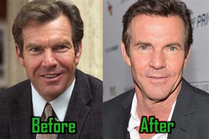 Unmasking Dennis Quaid's Plastic Surgery Journey: Before And After Revelations