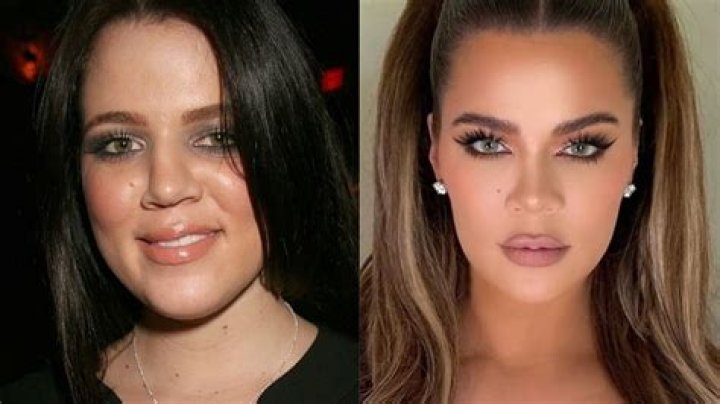 Khloe Kardashian's plastic surgery secrets revealed