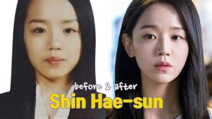 Shin Hye Sun's Plastic Surgery Journey: Before And After