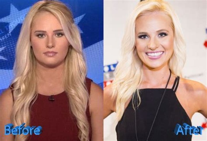 Unveiling Tomi Lahren's Nose Job: Discoveries And Insights